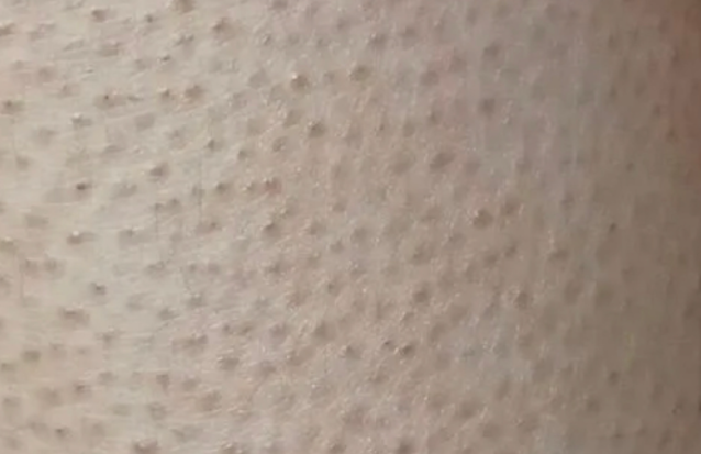 哺乳期皮肤干燥有鸡皮肤(哺乳期皮肤干燥有鸡皮肤怎么回事)