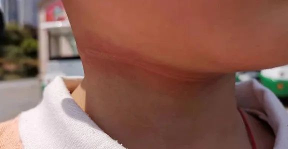 伤痕十分醒目皮肤表皮已经被损伤伤痕顺着脖子一周足足有十多厘米长勒