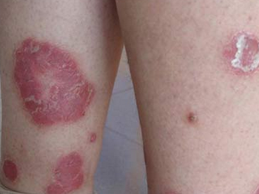 红皮病症状有哪些