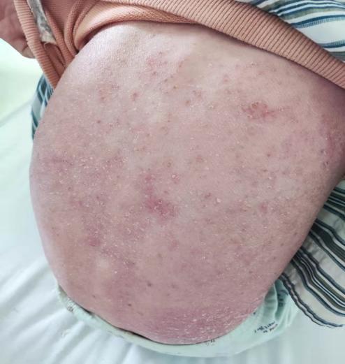 银屑病女孩韦纺在北京京城皮肤医院完成治疗