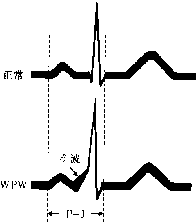 房颤心电图怎么画图片