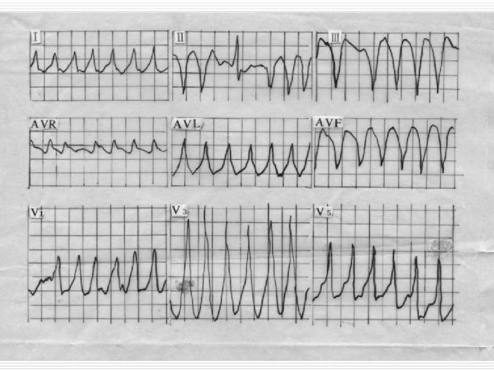 室颤室扑心电图特点图片