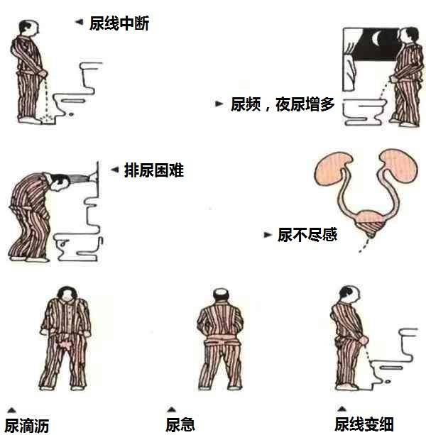 泌尿系结石：一种常见的健康问题
