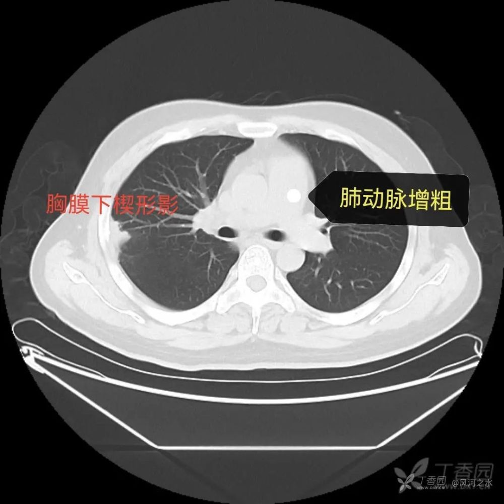 临床干货|一文读懂肺栓塞的诊断与治疗_腾讯新闻