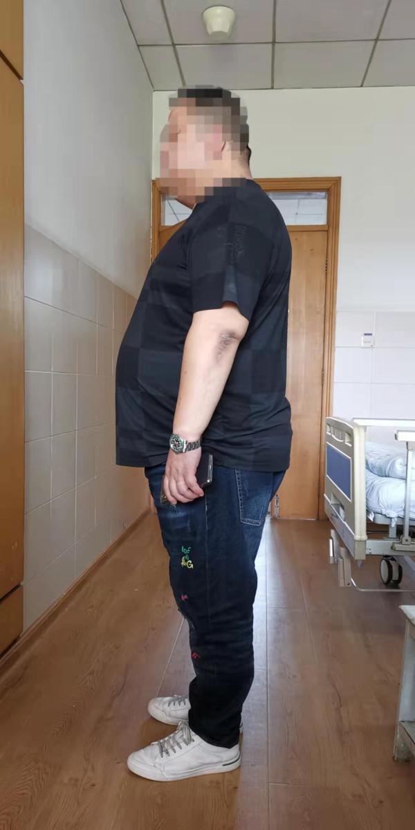 切掉80的胃后250斤小伙减重20斤肥胖曾让他等红绿灯时秒睡