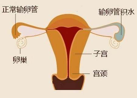 女性盆腔感染后,炎症若未及时彻底治愈,炎性渗出物会不断积聚超过机体