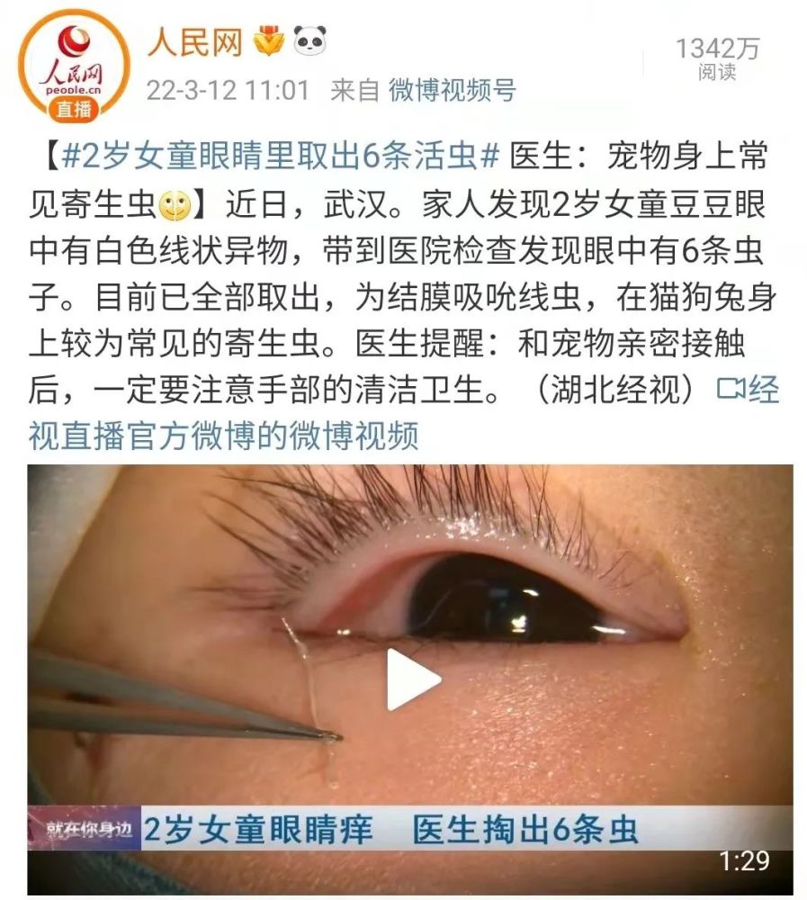 經過醫生診斷,這名兩歲女童染上了結膜吸吮線蟲,常寄生於哺乳類或鳥類