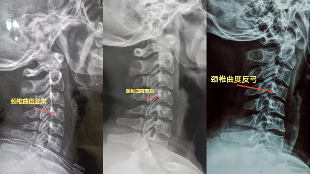 颈椎生理曲度消失图片