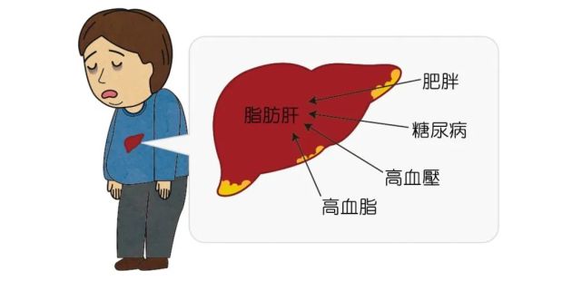 輕度脂肪肝患者可無明顯不適;中-重度脂肪肝患者則可能有噁心,嘔吐