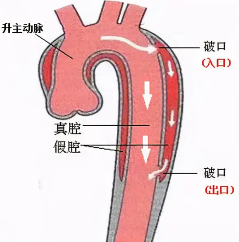 主动脉裂孔图片