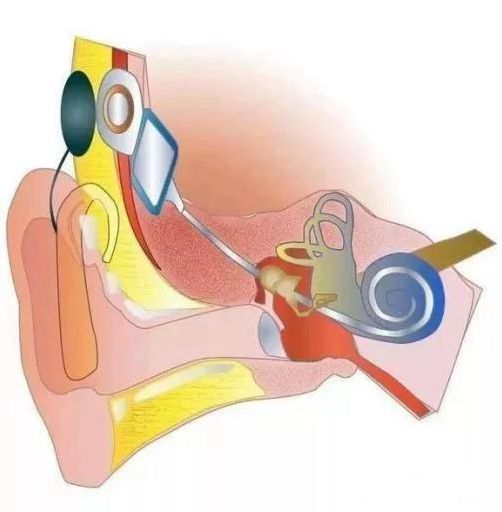 關於人工耳蝸植入大家都瞭解嗎?