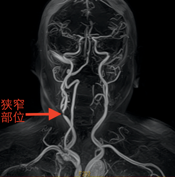 3dslicer在颈动脉内膜剥脱术中的应用