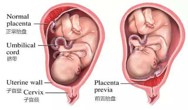 哪些人最容易發生前置胎盤呢