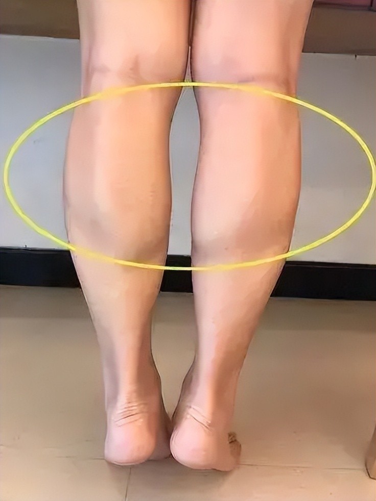 刘涛跑步消水肿,你为啥跑出了浮肿?_腾讯新闻