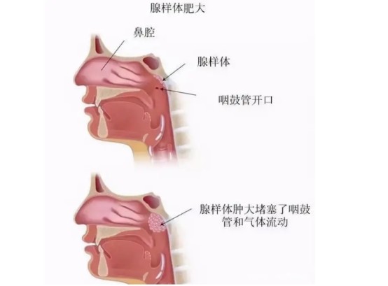 孩子鼻塞,流鼻涕要注意,腺樣體肥大不可忽視