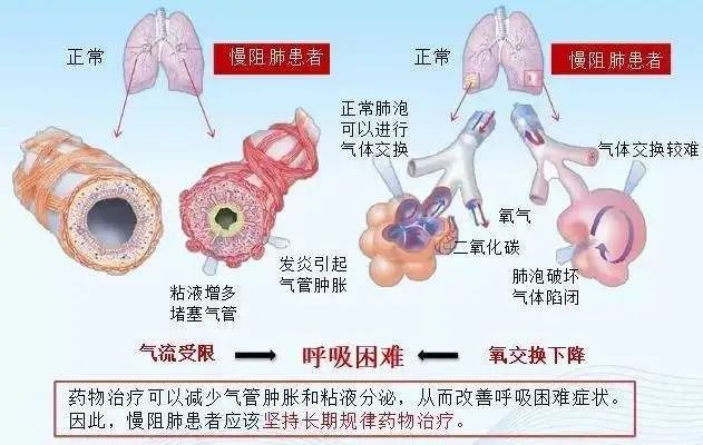 中医能治疗肺部疾病吗_白肺是可以治愈的吗中医_白肺吃什么中药