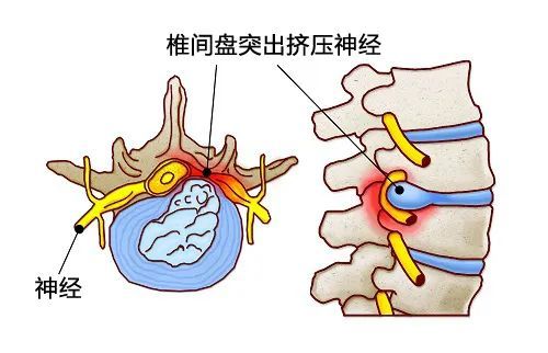 頸肩脖子痛注意椎間盤突出的可能2個動作測出頸椎健康