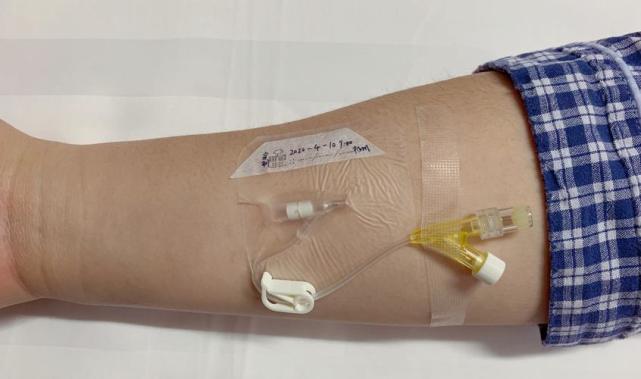 输液意外鼓包皮肤溃烂一只手差点截肢