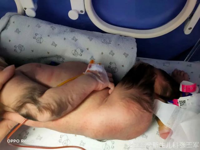 看图识病新生儿全身大片浓密毛发如何诊断