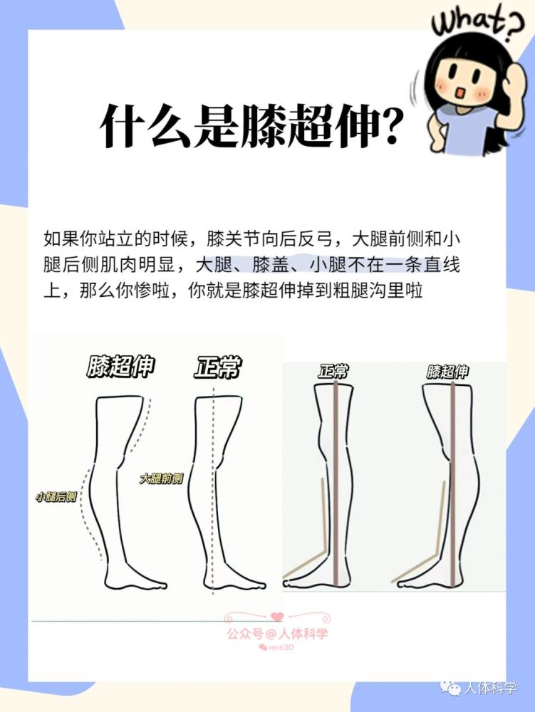 【不良体态】拒绝小粗腿,2招告别膝超伸_腾讯新闻