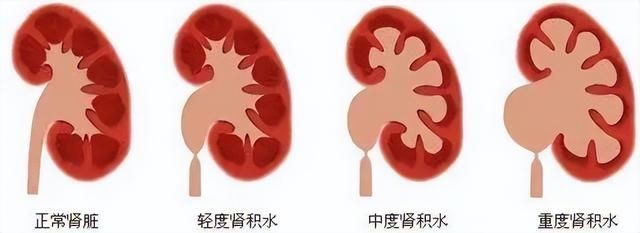 肾结石痛起来要人命防治办法看这里