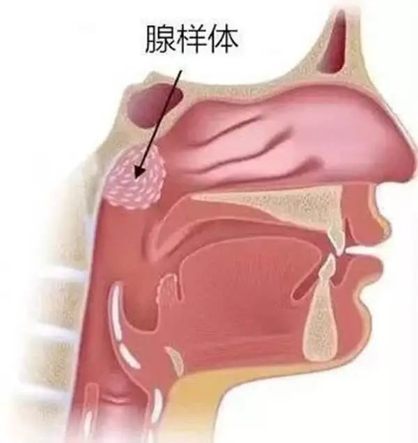 兒童長期患腺樣體肥大會怎麼樣?