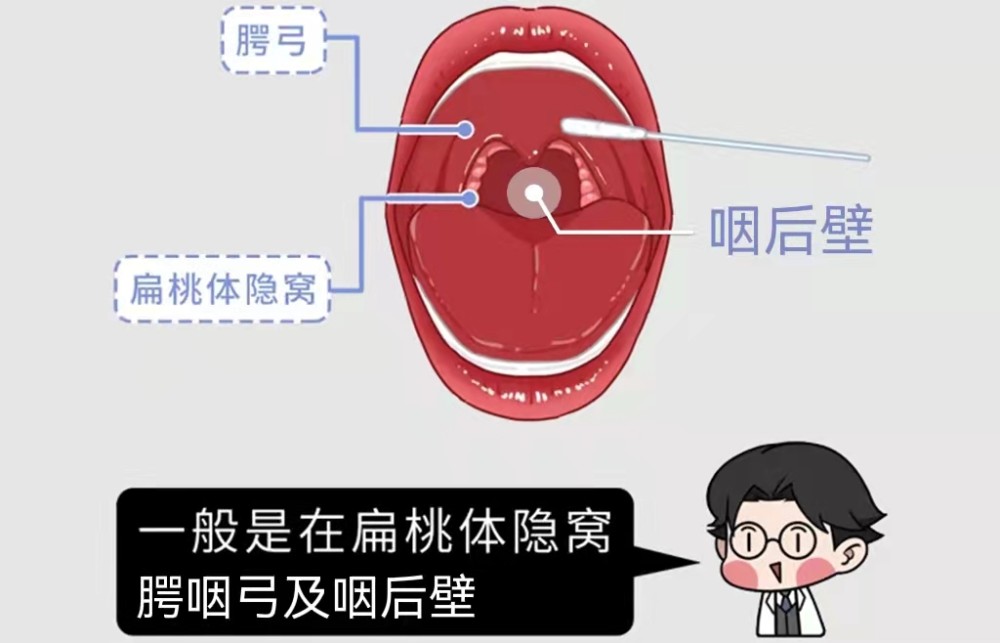 取出拭子的时候,避免触及舌头,悬垂体,口腔黏膜和唾液