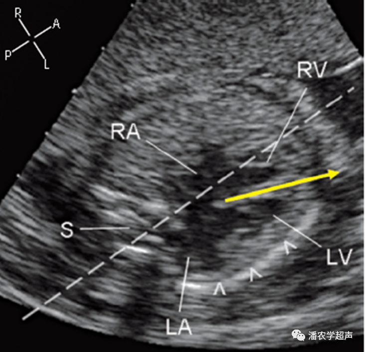 轴(黄色箭标)通常在左侧,距中线矢状面约70(白虚线,但心脏向左移位