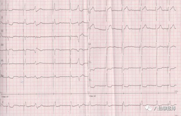 希氏束起搏心电图解读一例