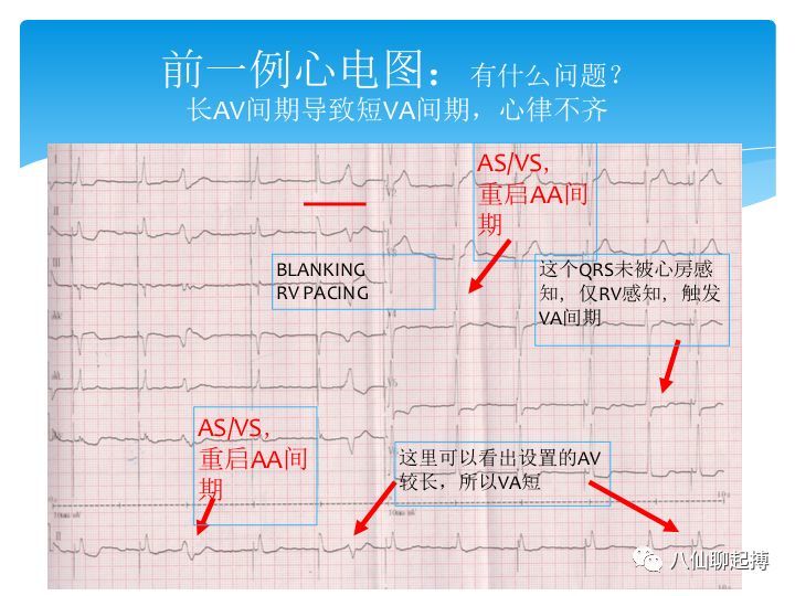 希氏束起搏心电图解读一例