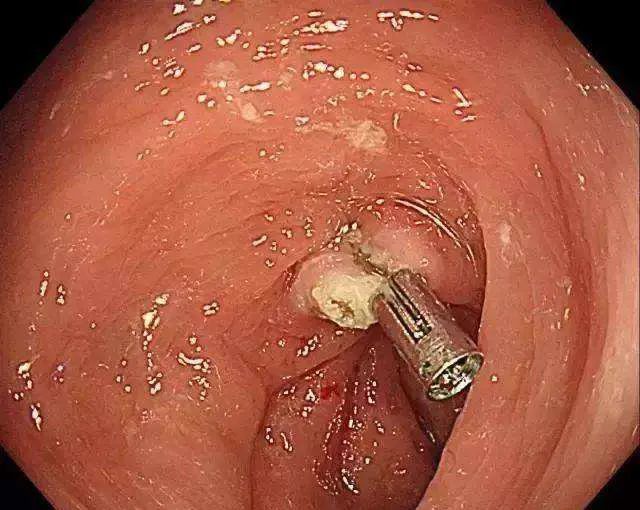 息肉是癌的近亲用艾灸对付它