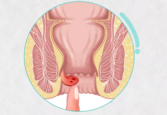 西安东大肛肠医院丨内痔长期不治有什么危害?长期不愈可诱发这些疾病