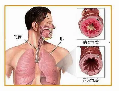 慢性炎症状气管支体征是什么_慢性支气管炎的症状和体征_慢性气管炎支气管炎症状