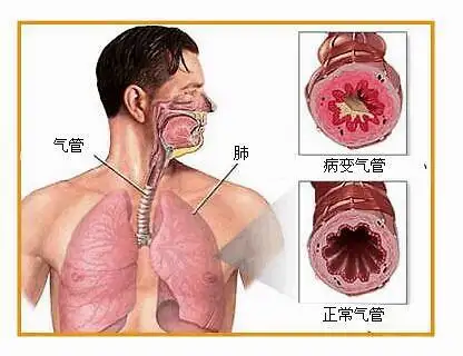 劉建博教授急慢性支氣管炎患者有哪些特徵