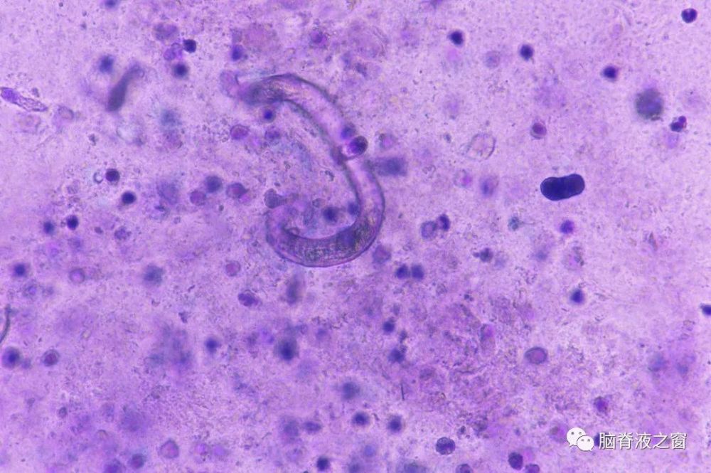 粪便及肺泡灌洗液查见的粪类圆线虫华山细胞形态专栏13