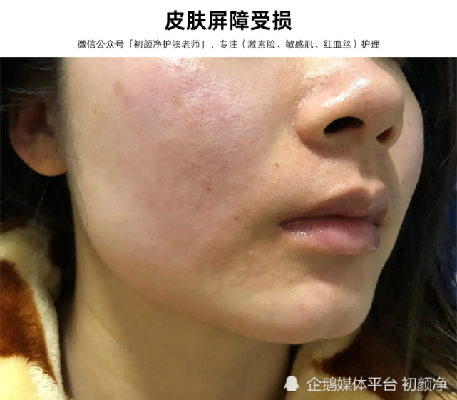 激素脸大多都是作出来的,皮肤9个异样早就告诉你,皮肤屏障受损了!