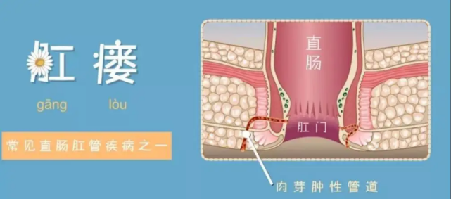 肛瘘与痔疮是有区别的,要去怎样预防呢