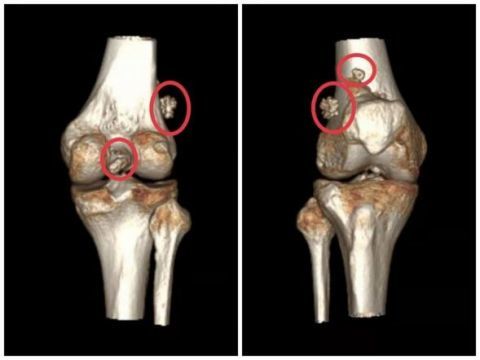 膝盖痛了好几个月竟然是关节里藏了老鼠