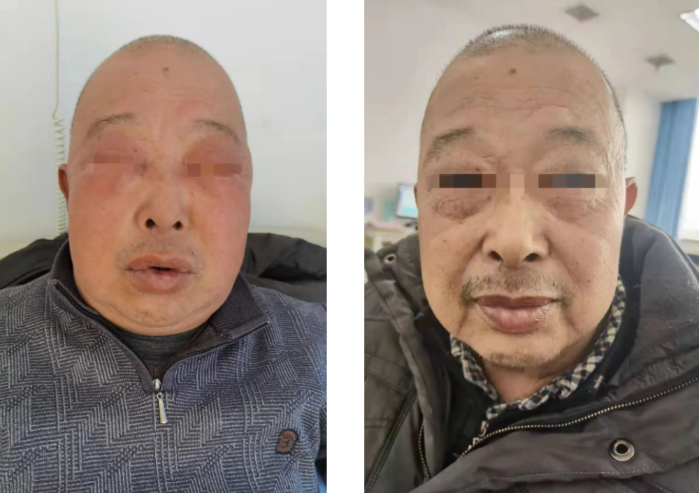 脸肿气促大爷患上小细胞肺癌10次放疗后改头换面