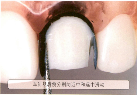 【牙醫必備】牙本質肩領的作用