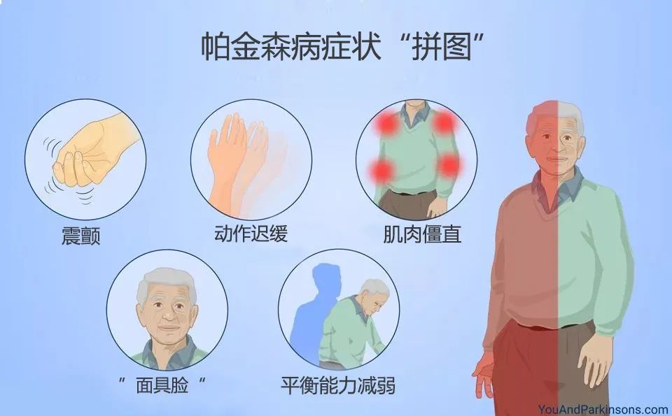 帕金森病有个迹象拼图协和医生推荐6个动作自测