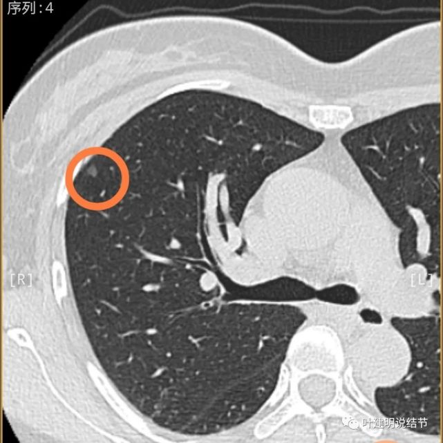 原位癌或微浸潤性腺癌可能性大右上病灶8:輪廓清楚的磨玻璃結節,不