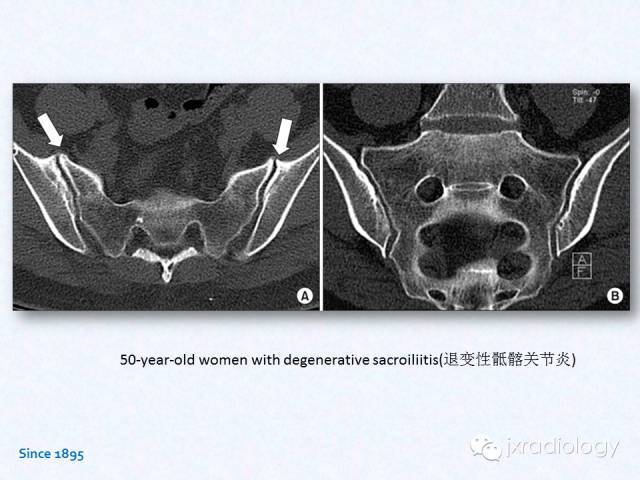 骶髂关节炎x线ct和mri表现