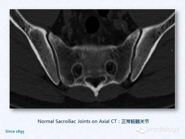 骶髂關節炎:x線,ct和mri表現