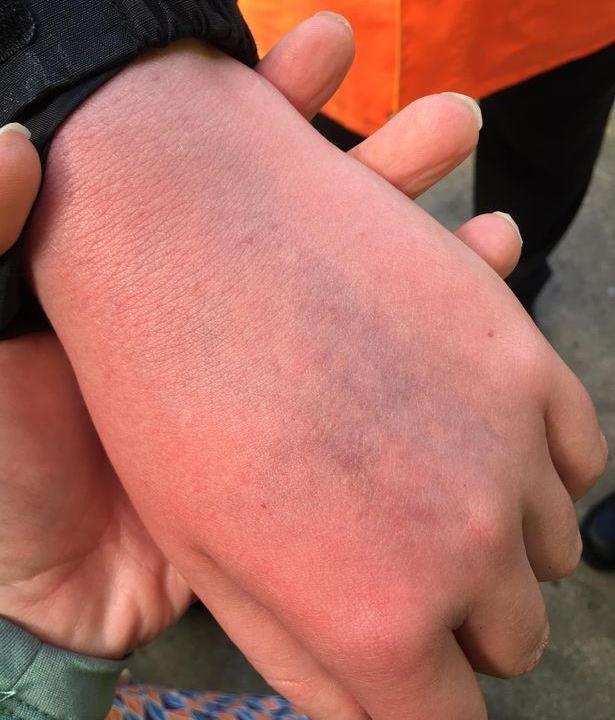 c罗这下麻烦了球迷妈妈我自闭症的儿子遭c罗攻击手背有淤青