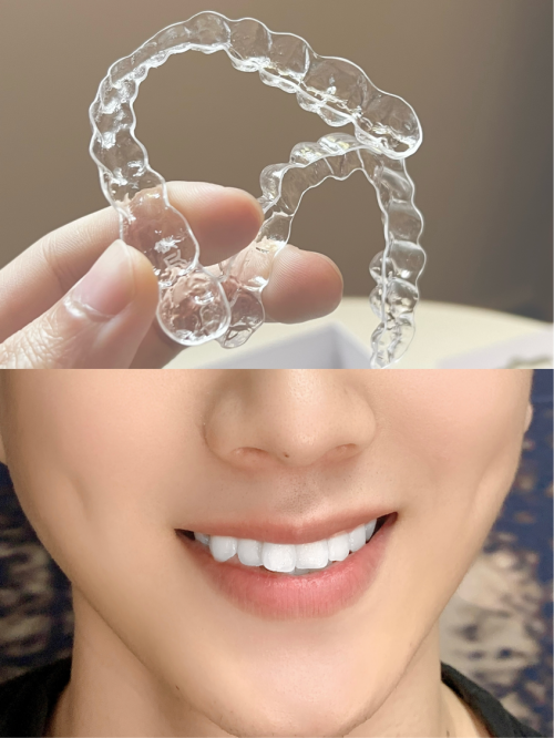 三十岁牙套妹的ai smile象贝正畸全过程