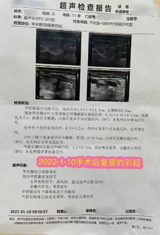 甲狀腺穿刺活檢提示:甲狀腺右葉乳頭狀癌.