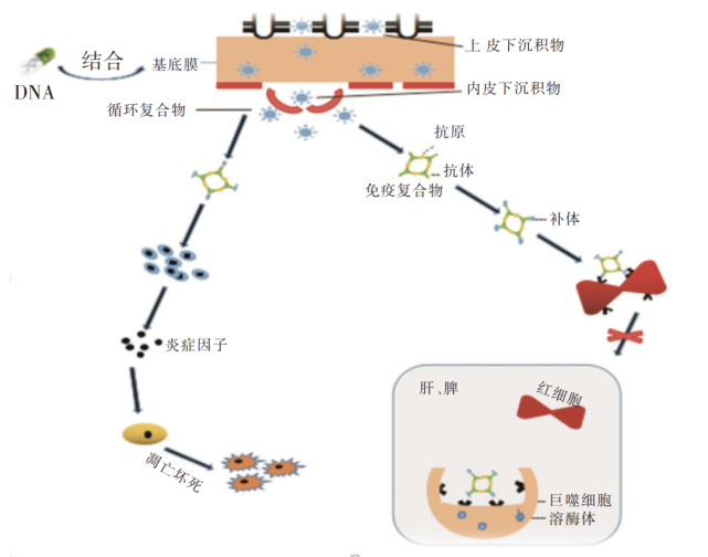 一文梳理狼瘡性腎炎發病機制,診斷及分型