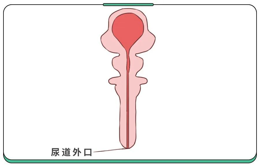 小孩尿道尿道口图片
