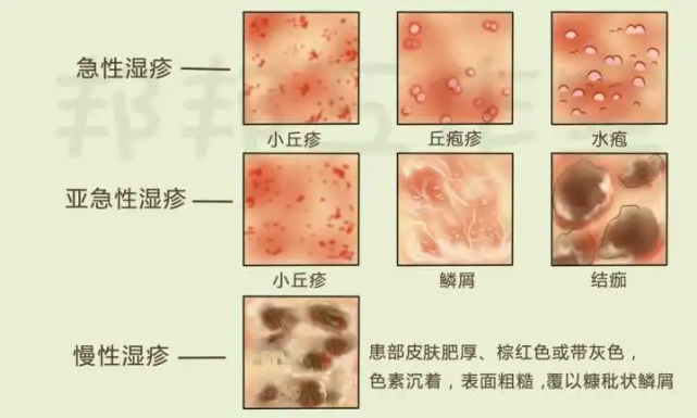 荨麻疹症状征兆?冬季荨麻疹怎么快速消退?
